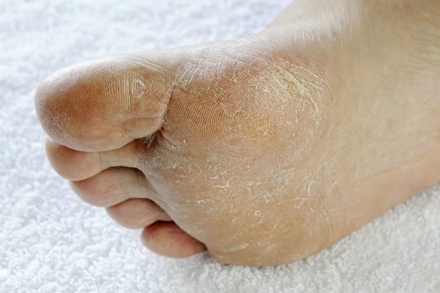 Микоз стопы – что это такое и как лечить?