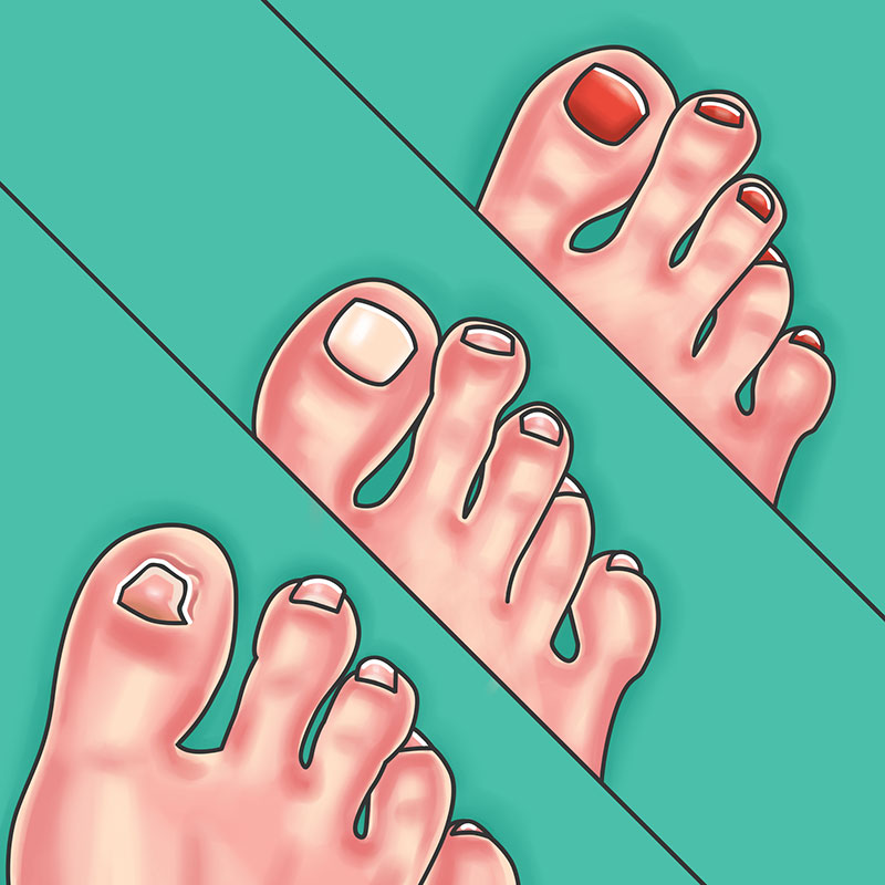 protezirovanie_nogtey