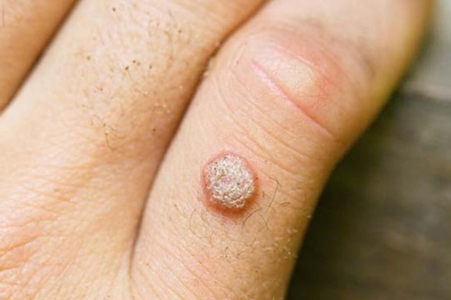 Вирусные бородавки - как вылечить бородавки на ногах?
