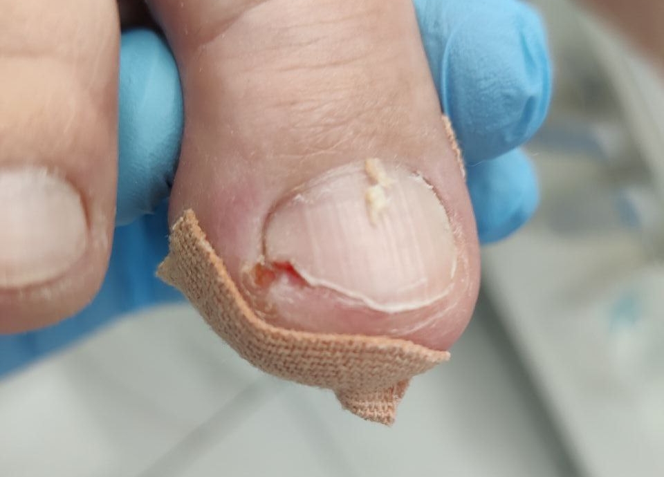 Лечение вросшего ногтя: современные методы и технологии подологии