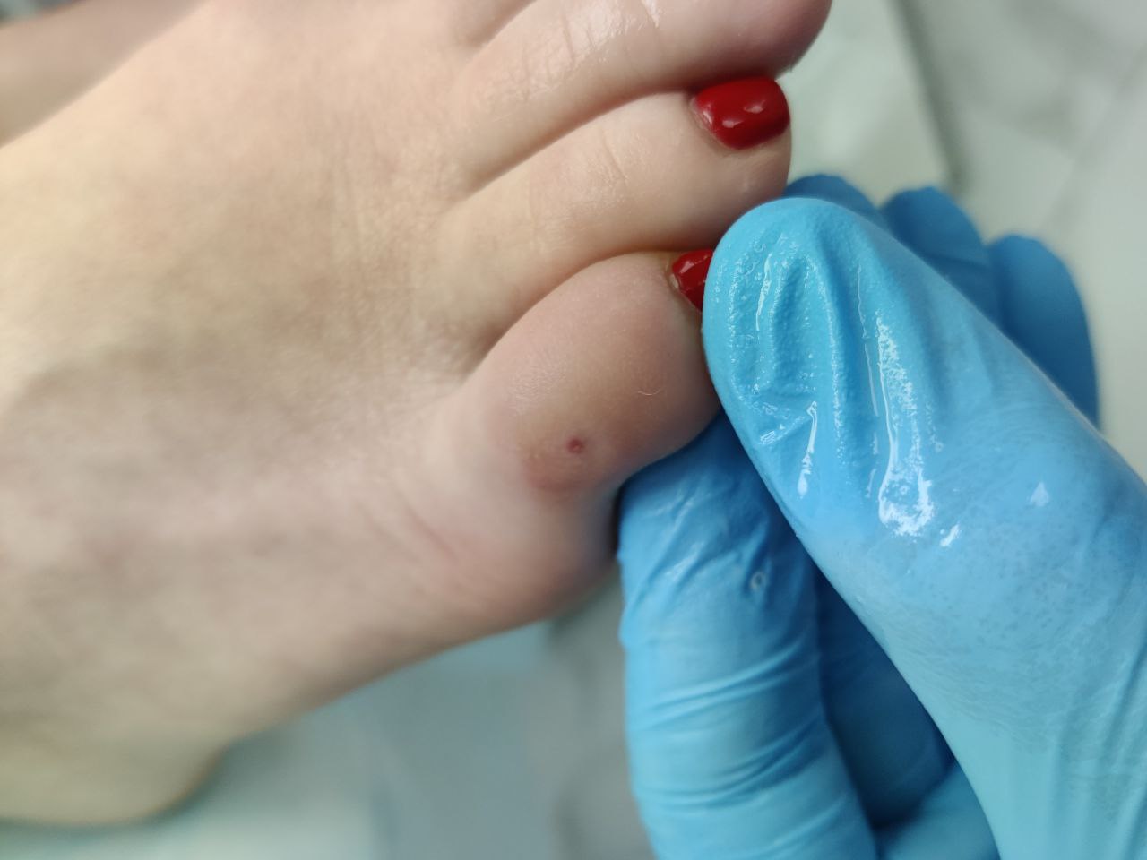 Мозоли и натоптыши: в чем разница и как лечить