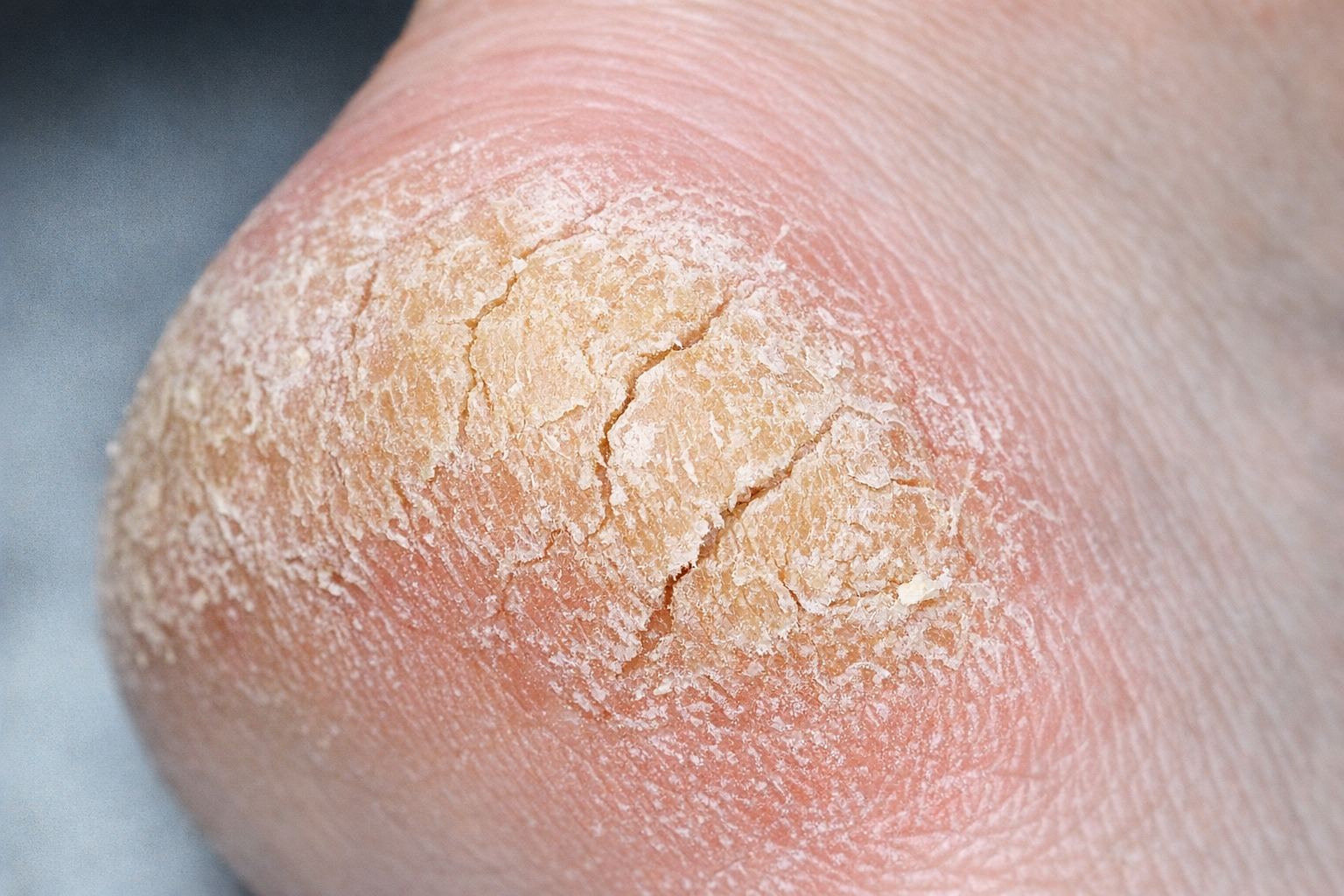 Гиперкератоз: что это, опасен ли и как лечить